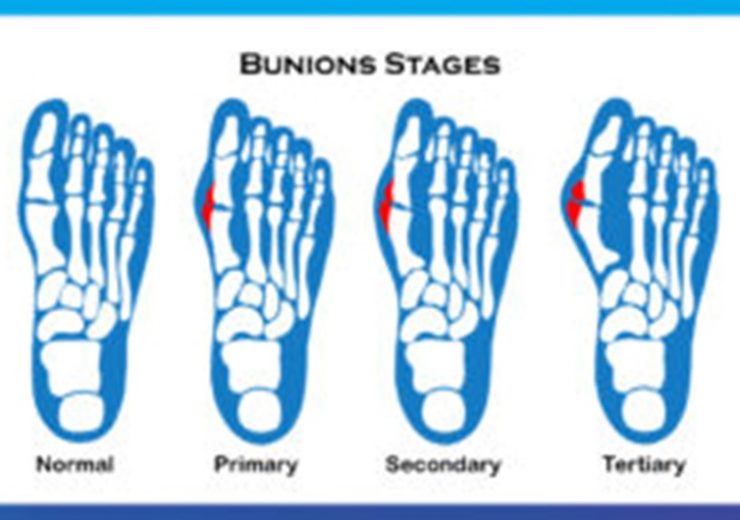 Bunions