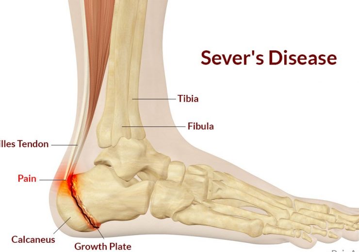 Sever-Disease